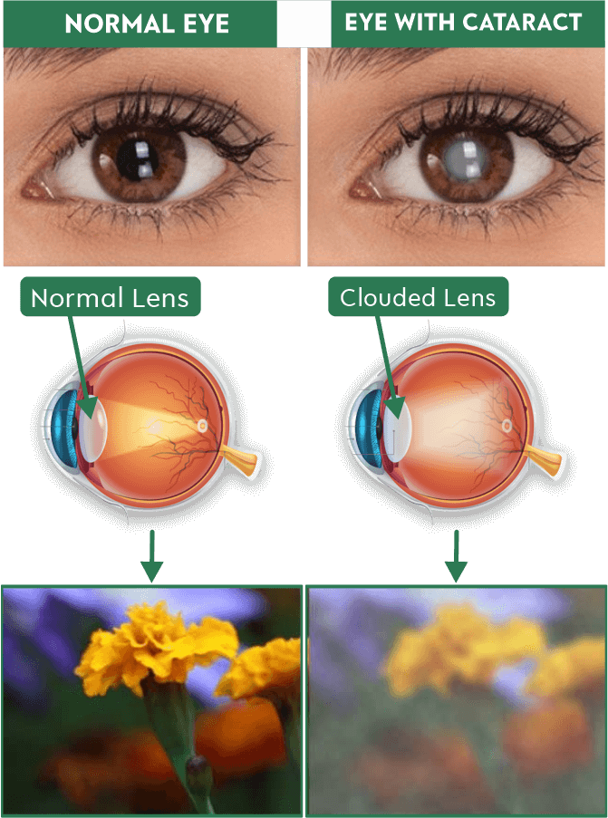 cataract surgery