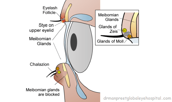 Stye eye infections