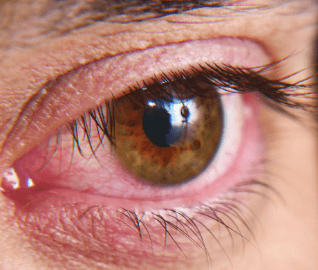 Dry eye