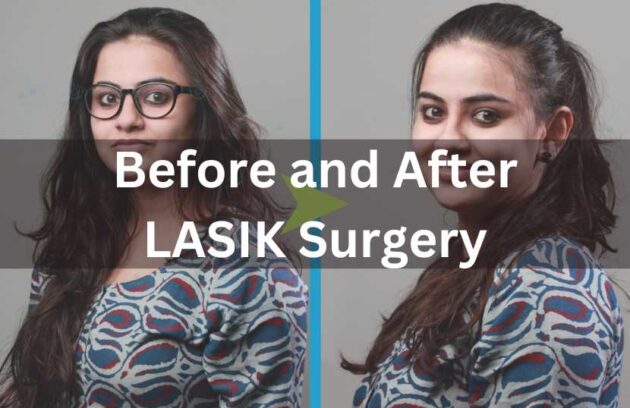 LASIK Surgery