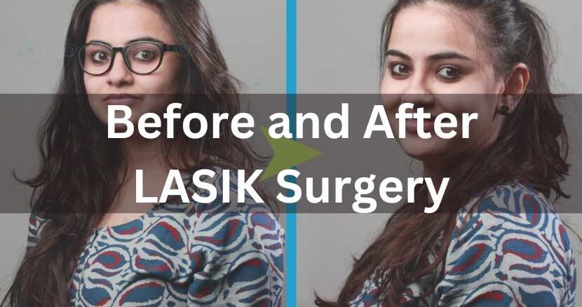 LASIK Surgery